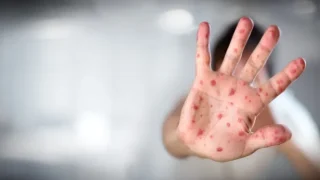 كل ما يجب معرفته عن داء الحصبة (بوحمرون)